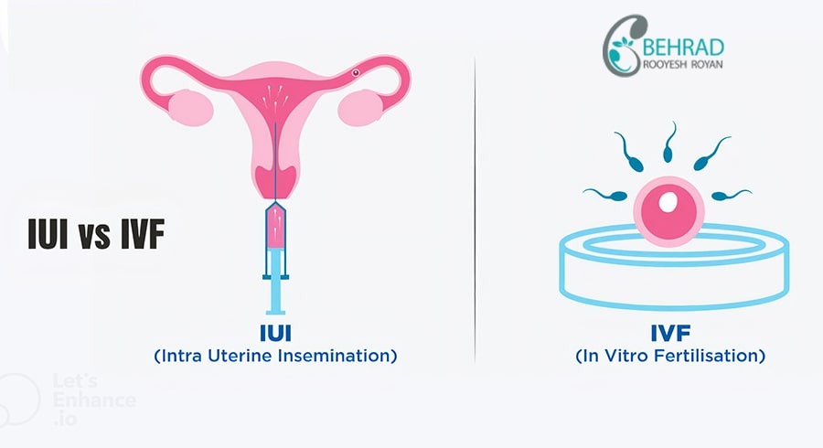 تفاوت روش های کمک باروری IVF و IUI
