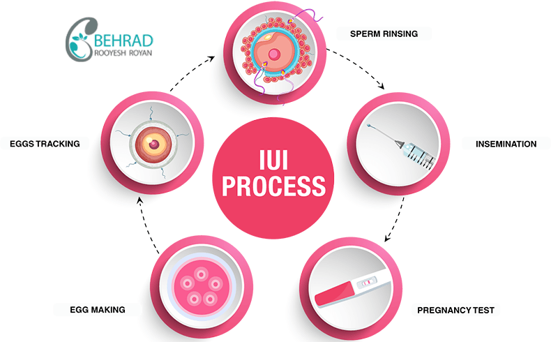 مراحل انجام روش iui