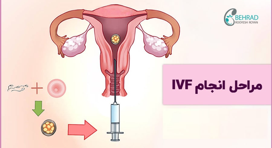 بارداری به روش ivf