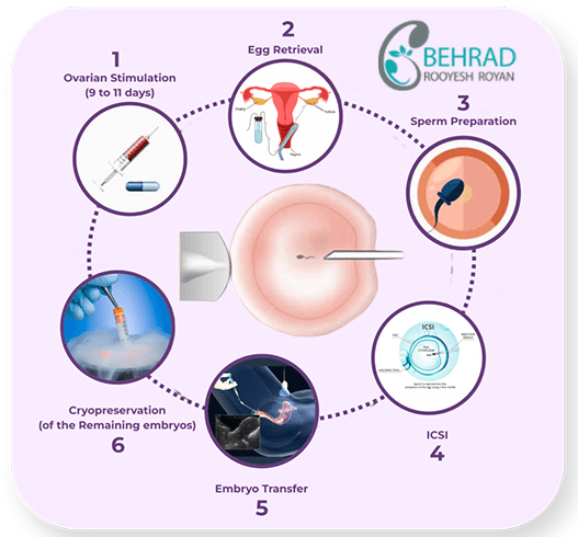 ICSI Infertility