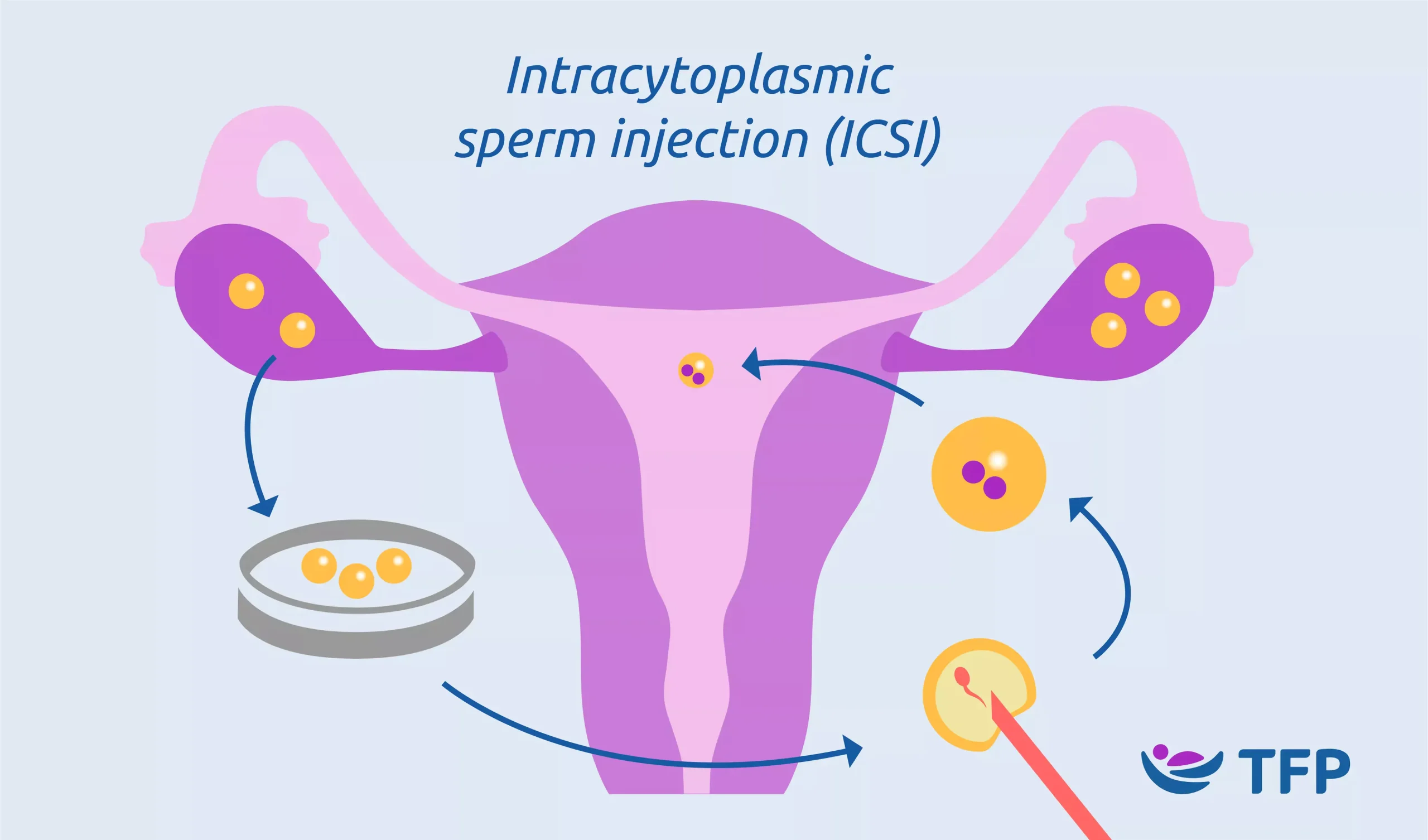 ICSI Treatment