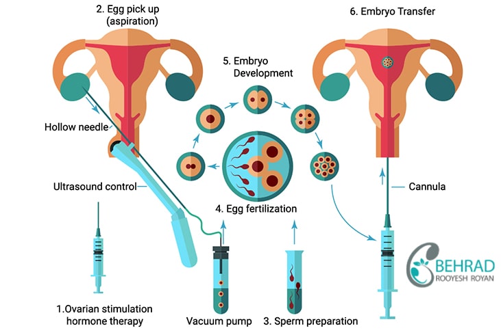 پروسه روش ivf
