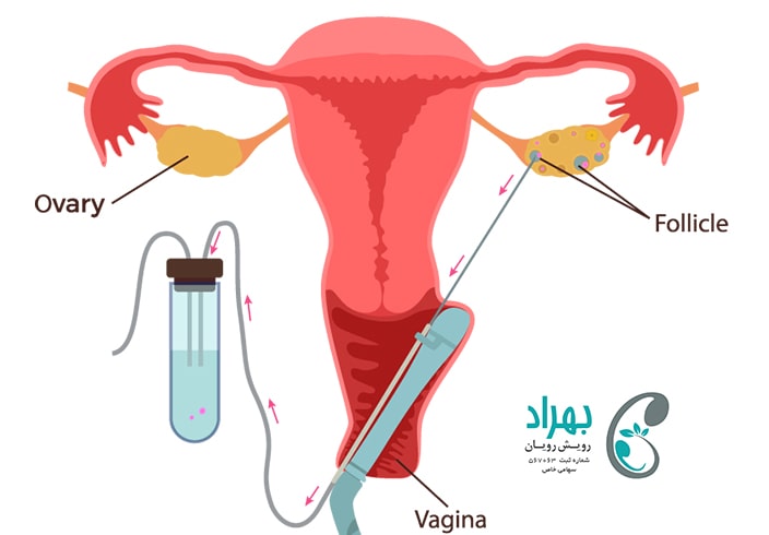 عمل انتقال جنین و بیهوشی