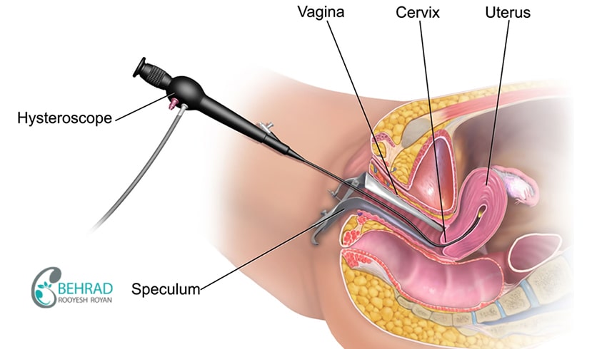 diagnostic curettage