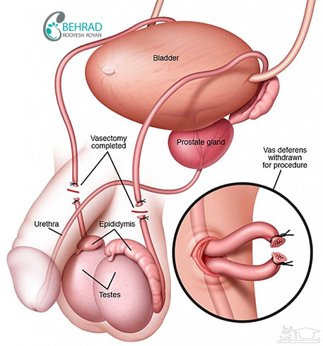 vasectomy surgery