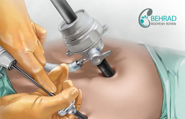 surgery laparoscopy