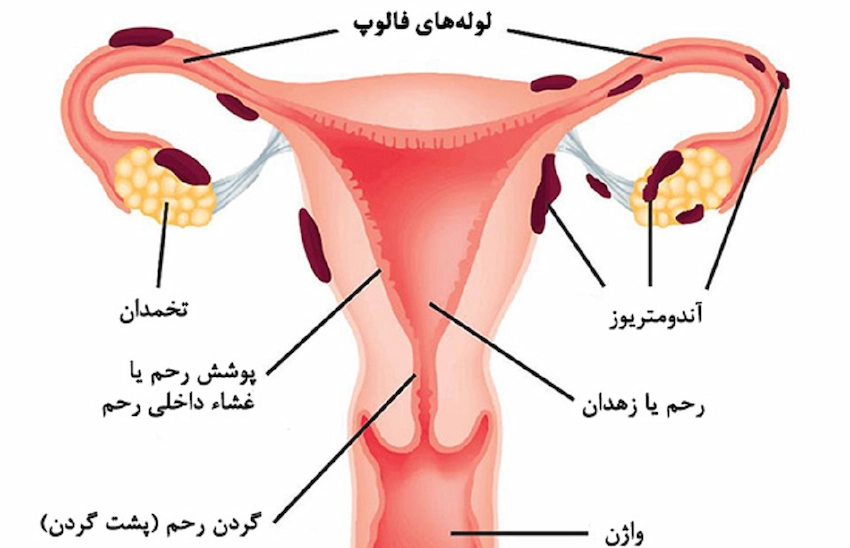آندومتریوز مشکلات رحمی