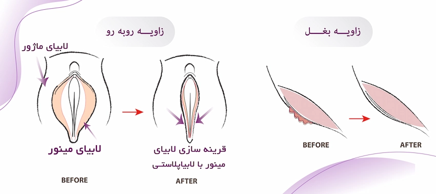 مراحل انجام لابیاپلاستی