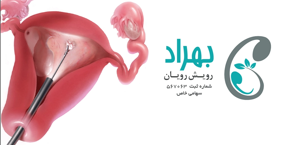 پولیپ رحمی