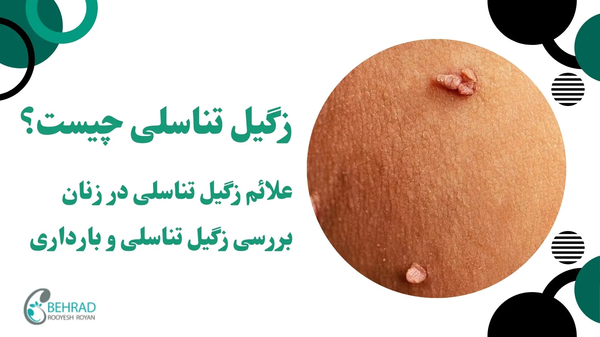 زگیل تناسلی چیست