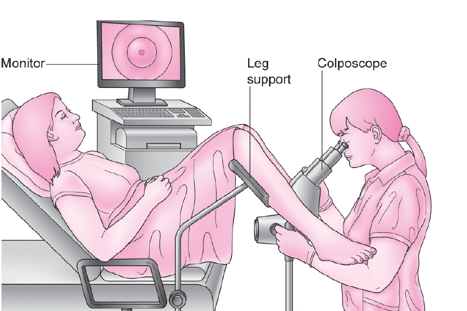 colposcopy