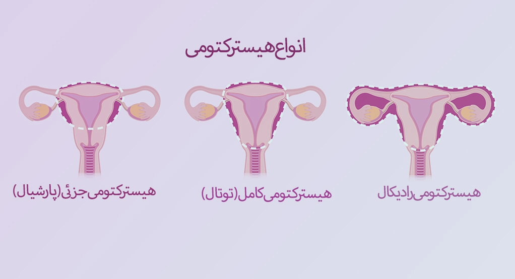 انواع هیسترکتومی