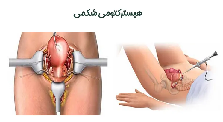 هیسترکتومی-شکمی