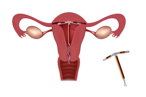 what is iud