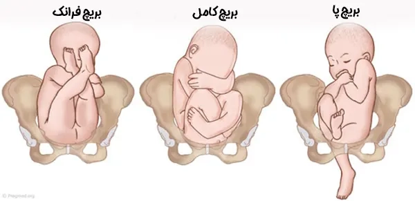 انواع بریچ