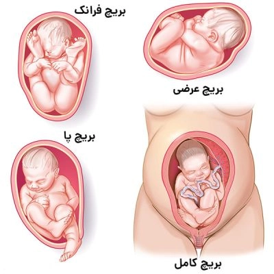 بریچ چیست