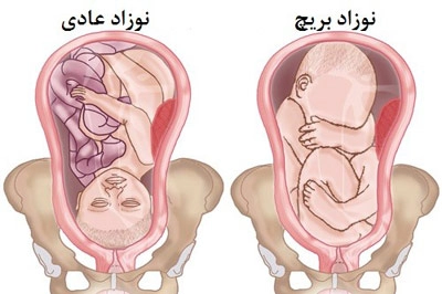 فرق بریج و نوزاد عادی
