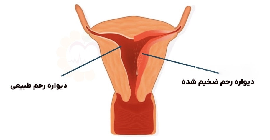 ضخامت دیواره رحم